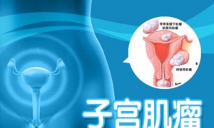 易发生子宫肌瘤的十大原因！