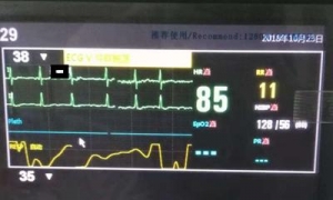 关于心电监护，这些你可能不懂