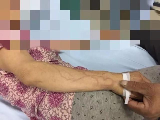 输液后病人胳膊上惊现红线！应对静脉炎这里有招