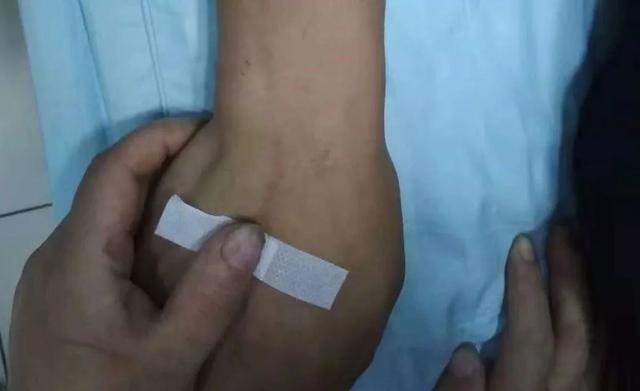 输液后病人胳膊上惊现红线！应对静脉炎这里有招